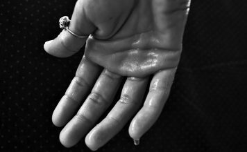 ניתוח הזעת יתר